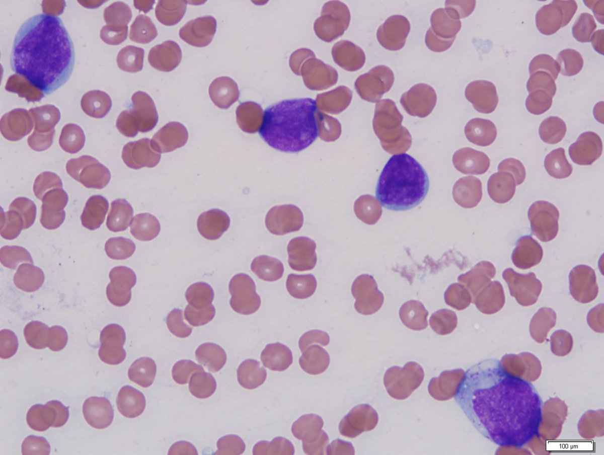 Blasts in bone marrow aspirate. Rare blasts show cytoplasmic granules